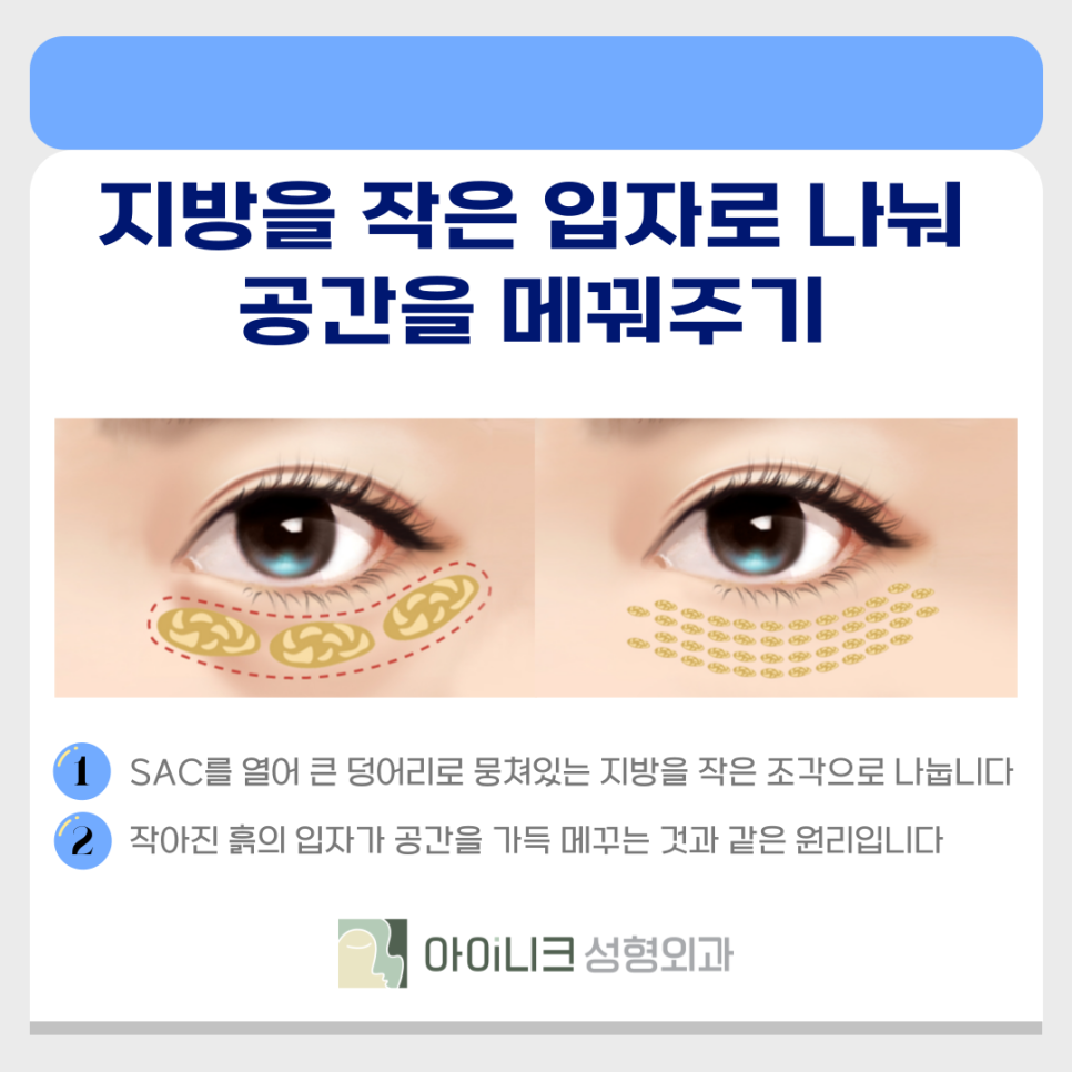 압구정 로데오 눈밑지로 노안 원인 주름 다크서클 개선하기 관련 이미지 7