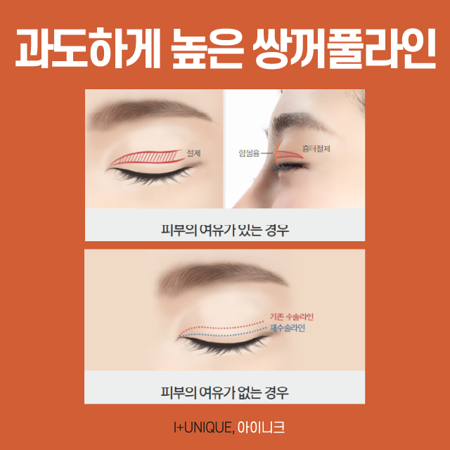 소세지눈 더 이상 고민 NO! 자연스러운 눈매를 위한 소세지 쌍꺼풀 수술 관련 이미지 3