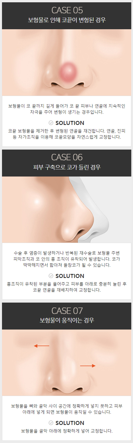 늑연골코재수술 안전한 보형물로 자연스럽게! 관련 이미지 5
