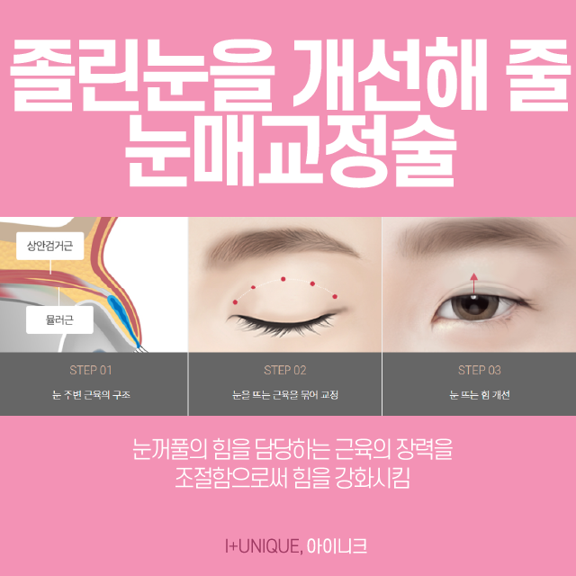 졸린 눈이 고민이라면 졸린눈성형인 눈매교정술로 또렷한 눈으로 거듭나기! 관련 이미지 3