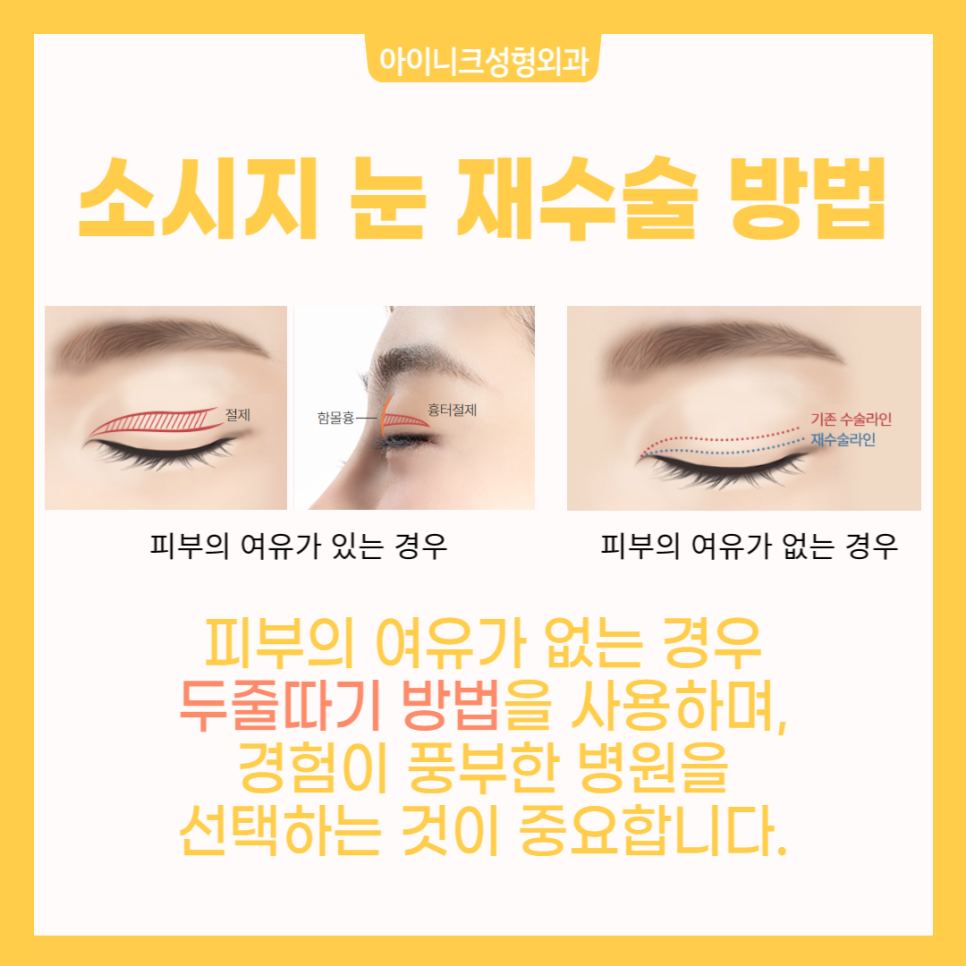 Creating Natural-Looking Eyes with Double Eyelid Line Revision Surgery image 4