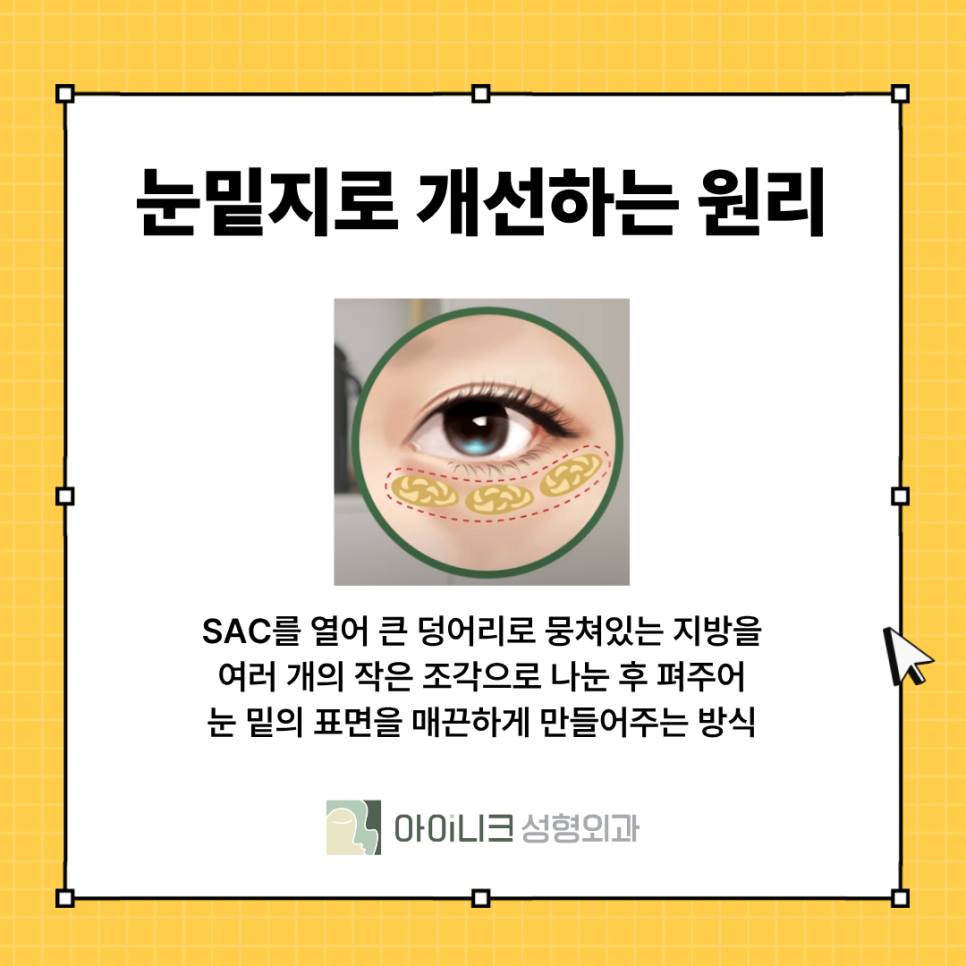 What Is the Standard for the Face During Encore Under-Eye Fat Repositioning? image 5
