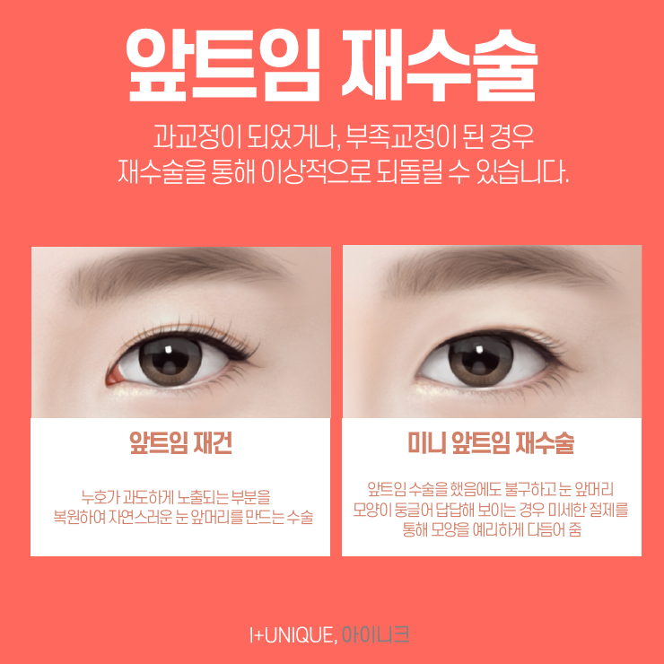 성형외과재수술은 보다 신중하게 결정하자 아이니크성형외과에서 관련 이미지 5