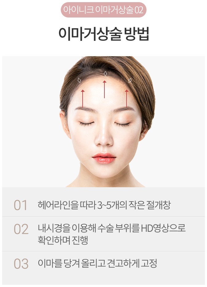 내시경이마거상으로 리프팅 효과까지! 관련 이미지 4
