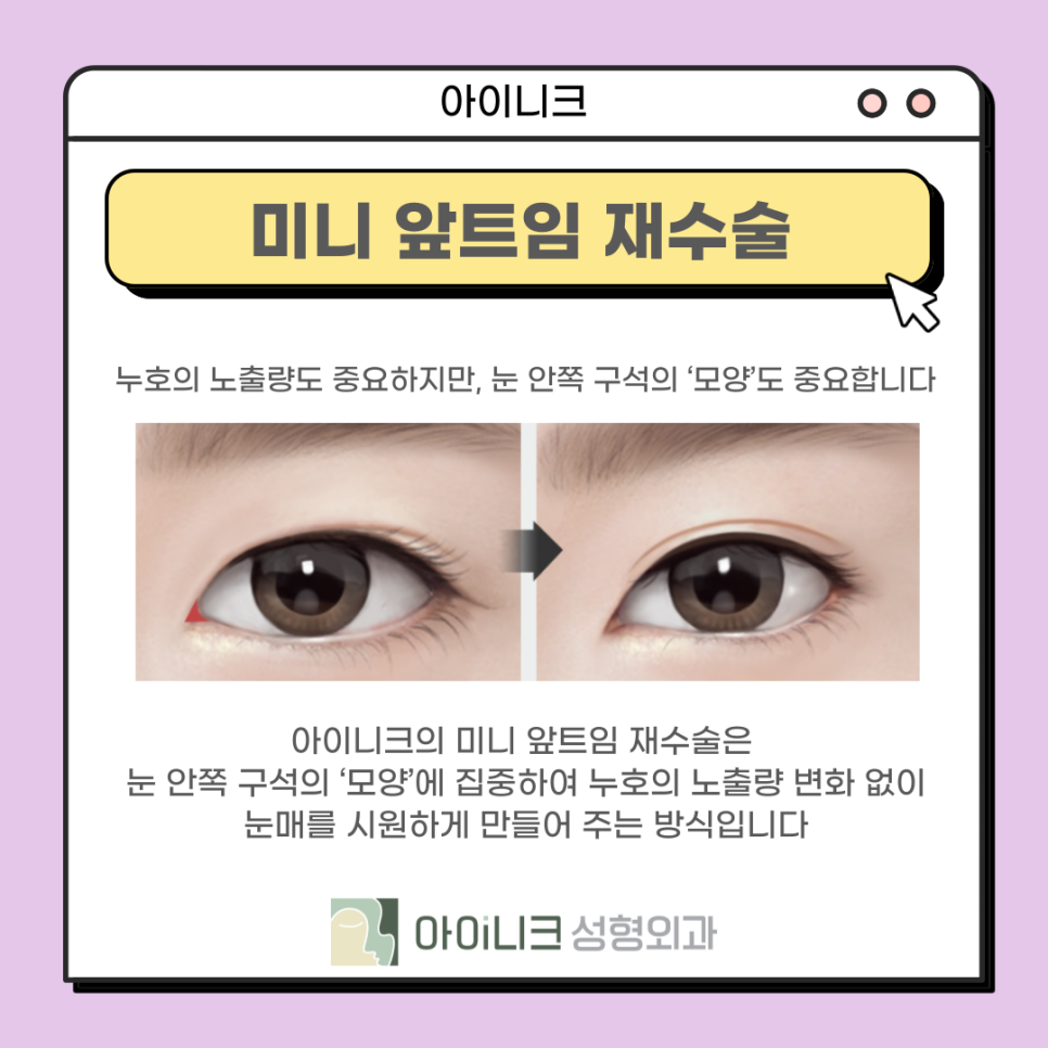 눈재수술성형외과 실패한 앞트임 재건 관련 이미지 13