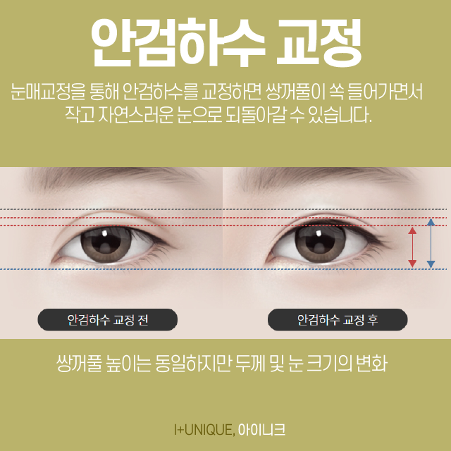 쌍수재수술병원을 고를 땐 의사의 실력이 중요합니다 관련 이미지 4