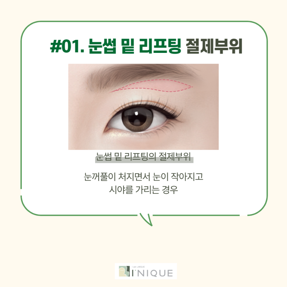 중년눈성형을 통해 다시 젊고 자신있게! 관련 이미지 2