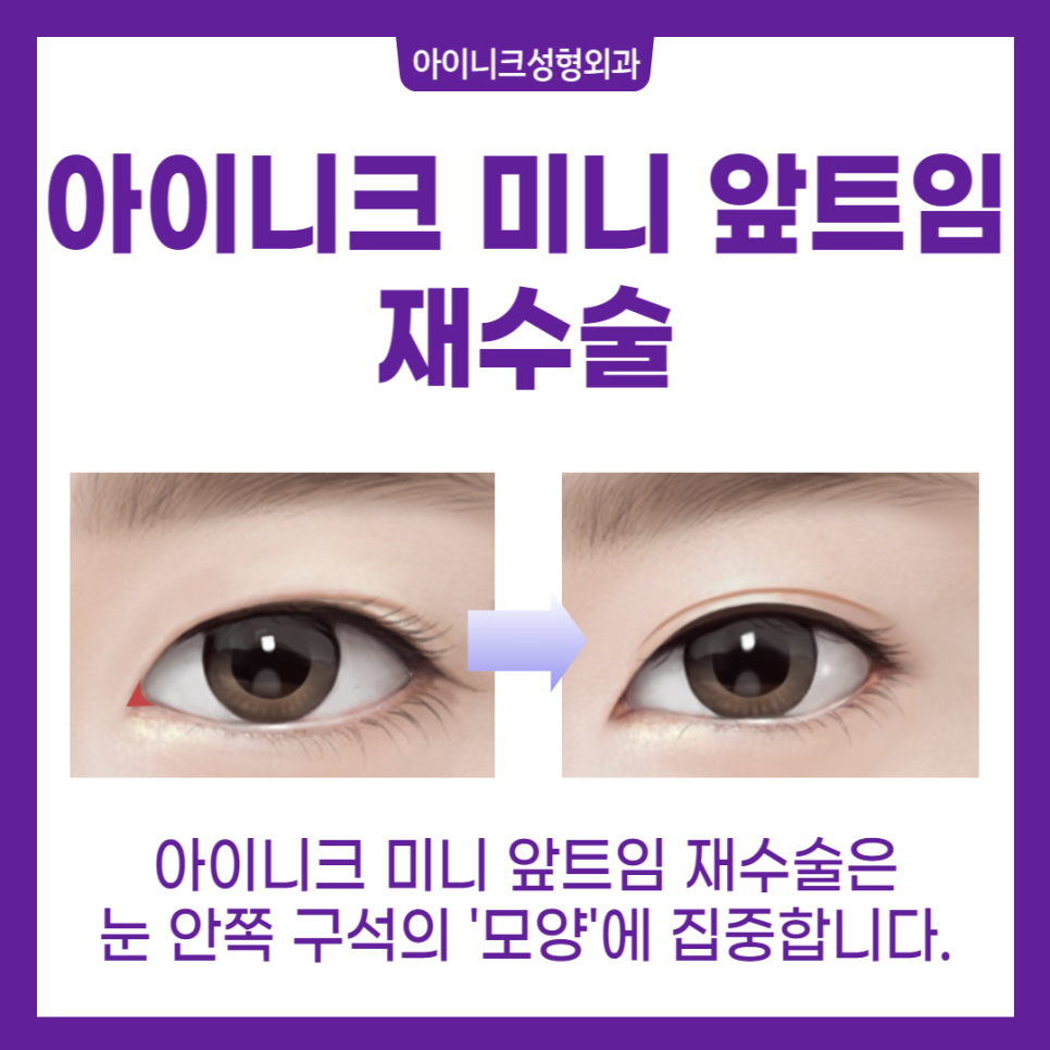 앞트임재수술잘하는곳, 여기! 관련 이미지 5