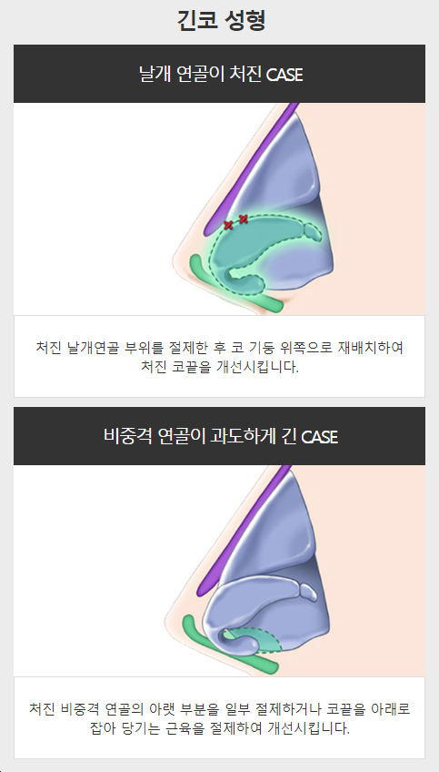 메부리코수술전후 매력적인 라인과 부드러운 인상으로! 관련 이미지 5