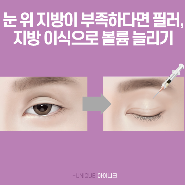 풀려버린 외꺼풀, 겹쌍꺼풀로 스트레스 받지 마세요! 관련 이미지 3