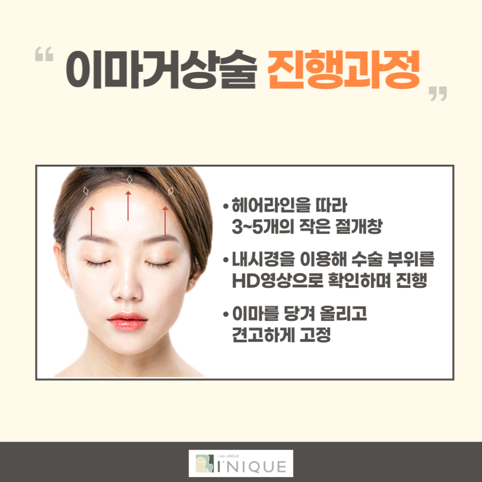 Forehead Lift Surgery in Your 20s: Effectively Improving Deep Wrinkles image 3