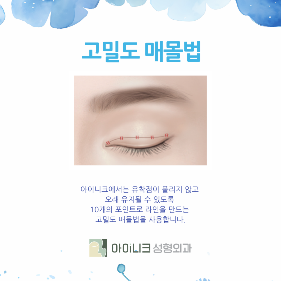 압구정쌍꺼풀 자연스럽게 예뻐지려면 관련 이미지 5