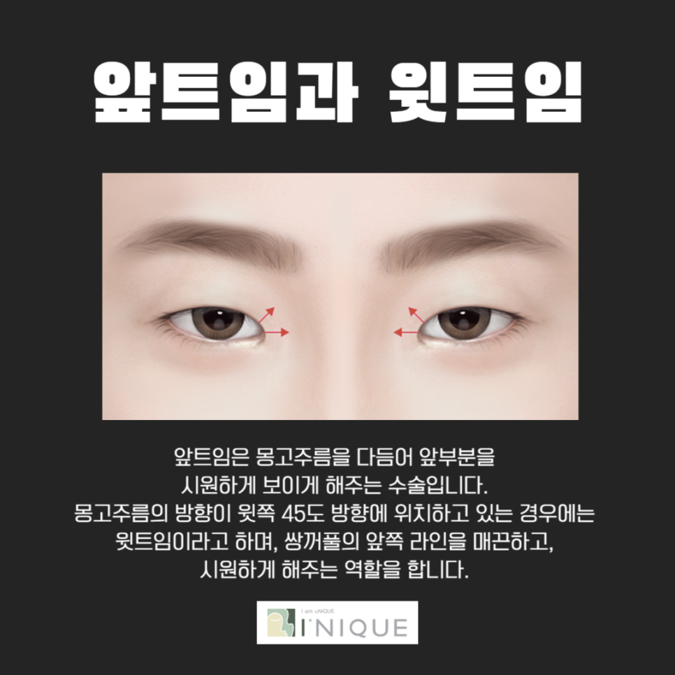 트임성형으로 답답한 눈매고민 해결 관련 이미지 4