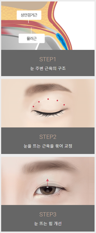 눈매교정술가격 좁은 시야를 개선하자! 관련 이미지 3