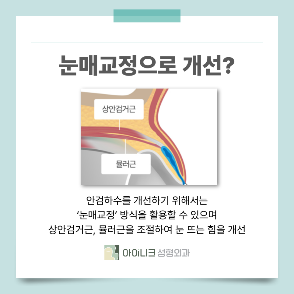 서울안검하수 눈꺼풀에 덮혀서 답답한 눈이라면? 관련 이미지 6