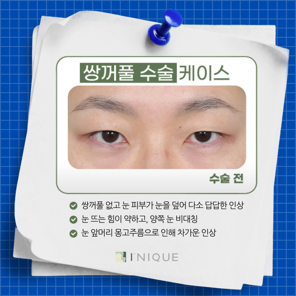 Apgujeong Eye Plastic Surgery Clinic: Let’s Decide by Looking at Real Surgery Cases! image 5