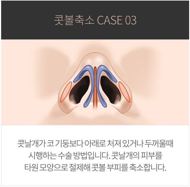 콧볼축소수술가격이 궁금하다면 click! 관련 이미지 6