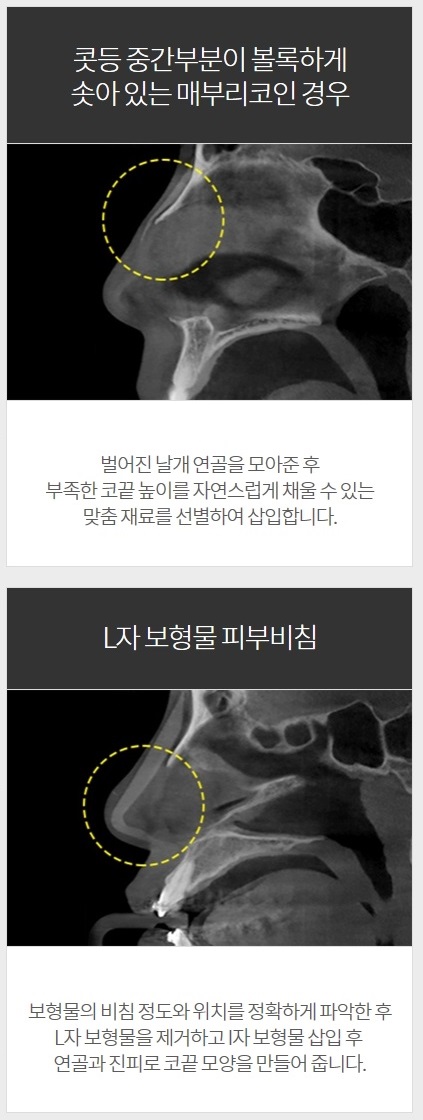 코구형구축 아이니크만의 솔루션이 정답! 관련 이미지 4