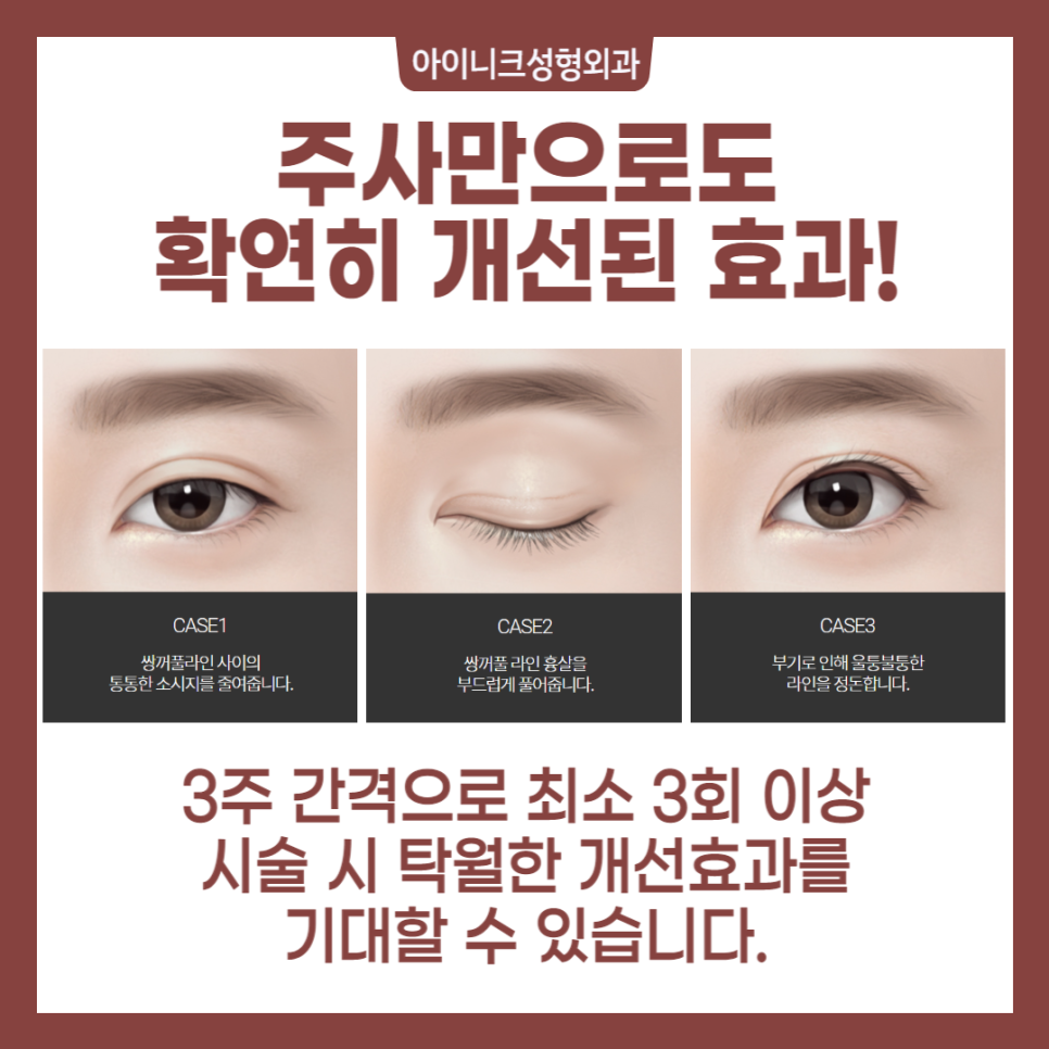 쌍꺼풀 붓기제거 효과적인 방법을 찾는다면 관련 이미지 5