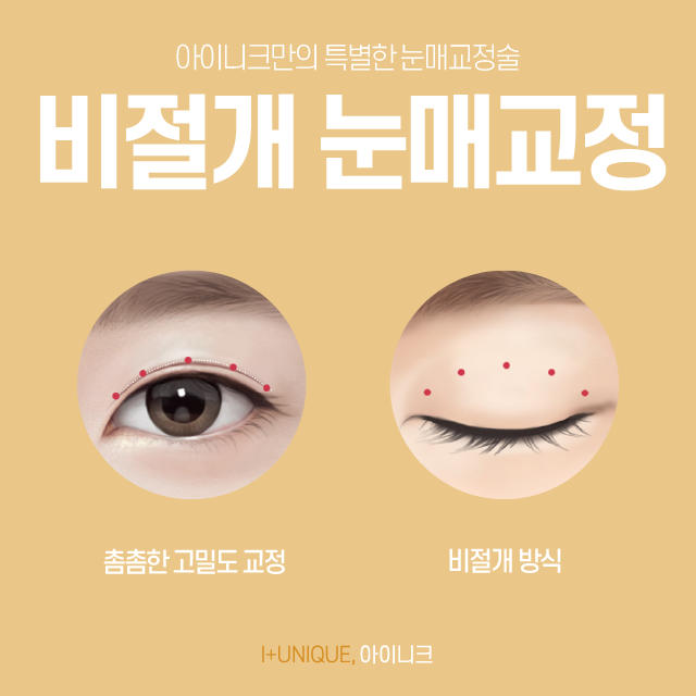 눈매교정수술, 당신이 안검하수라면 비절개눈매교정에 주목하세요. 관련 이미지 5
