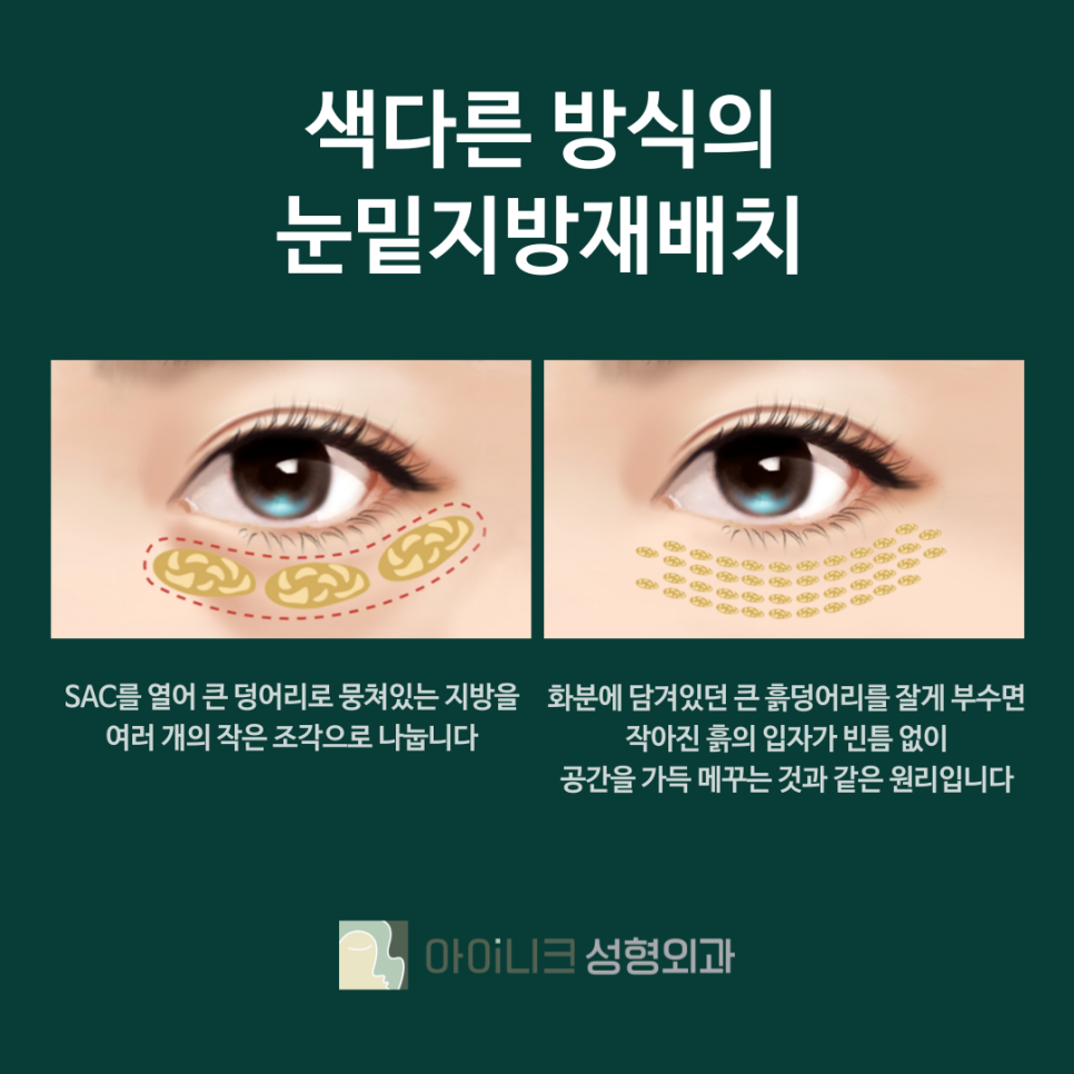 서울압구정눈밑지방재배치 잘하는곳 아이니크에서 환한 얼굴로 개선 관련 이미지 4