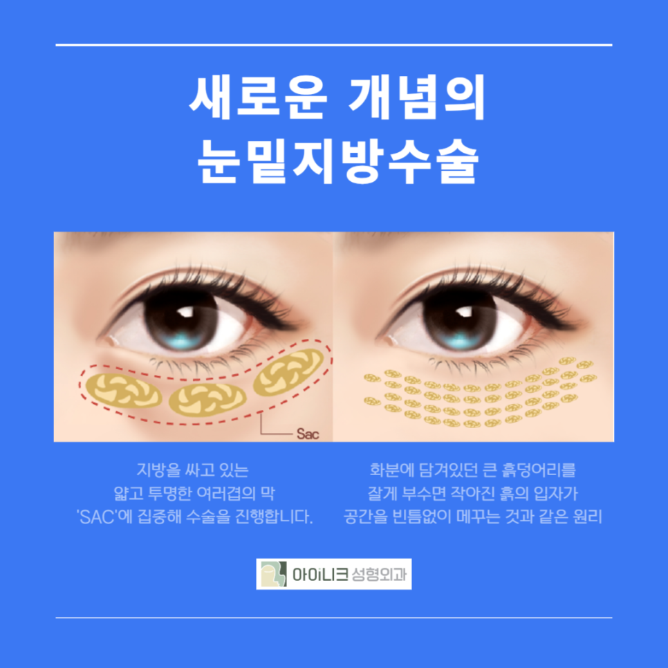 눈밑지방성형외과 찾기 어렵지 않아요 관련 이미지 3