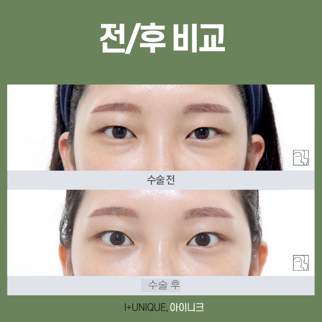 성공하는 눈밑지방수술 방법은? 관련 이미지 5