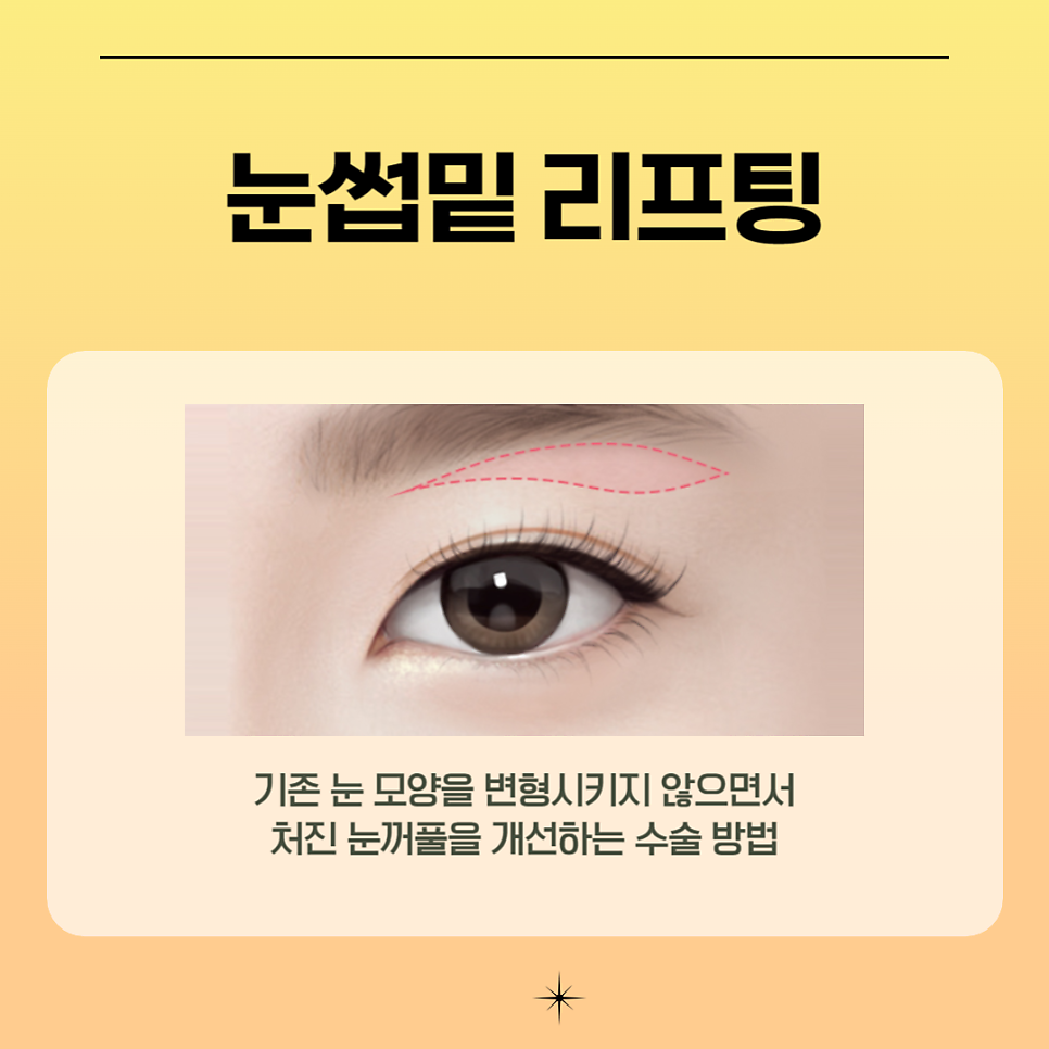 눈처짐수술 후기가 증명하는 아이니크 관련 이미지 3