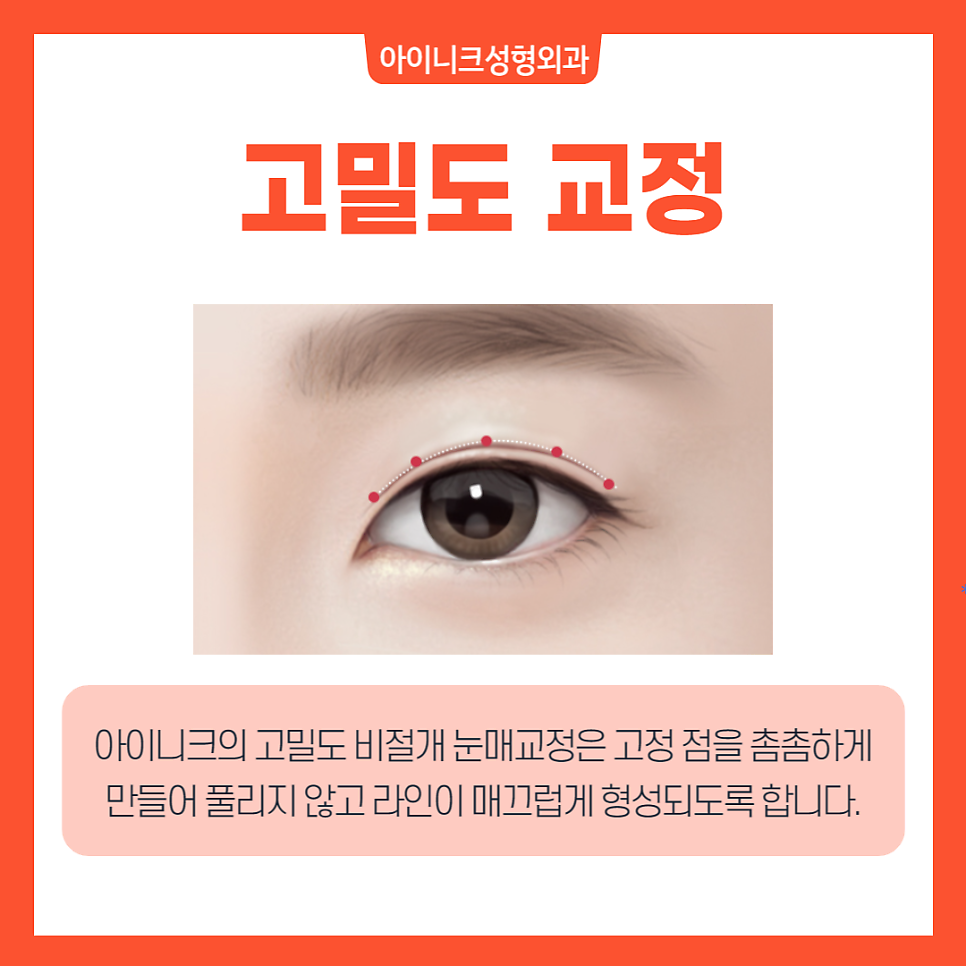 Apgujeong Ptosis: Correct It Without Incision! image 5