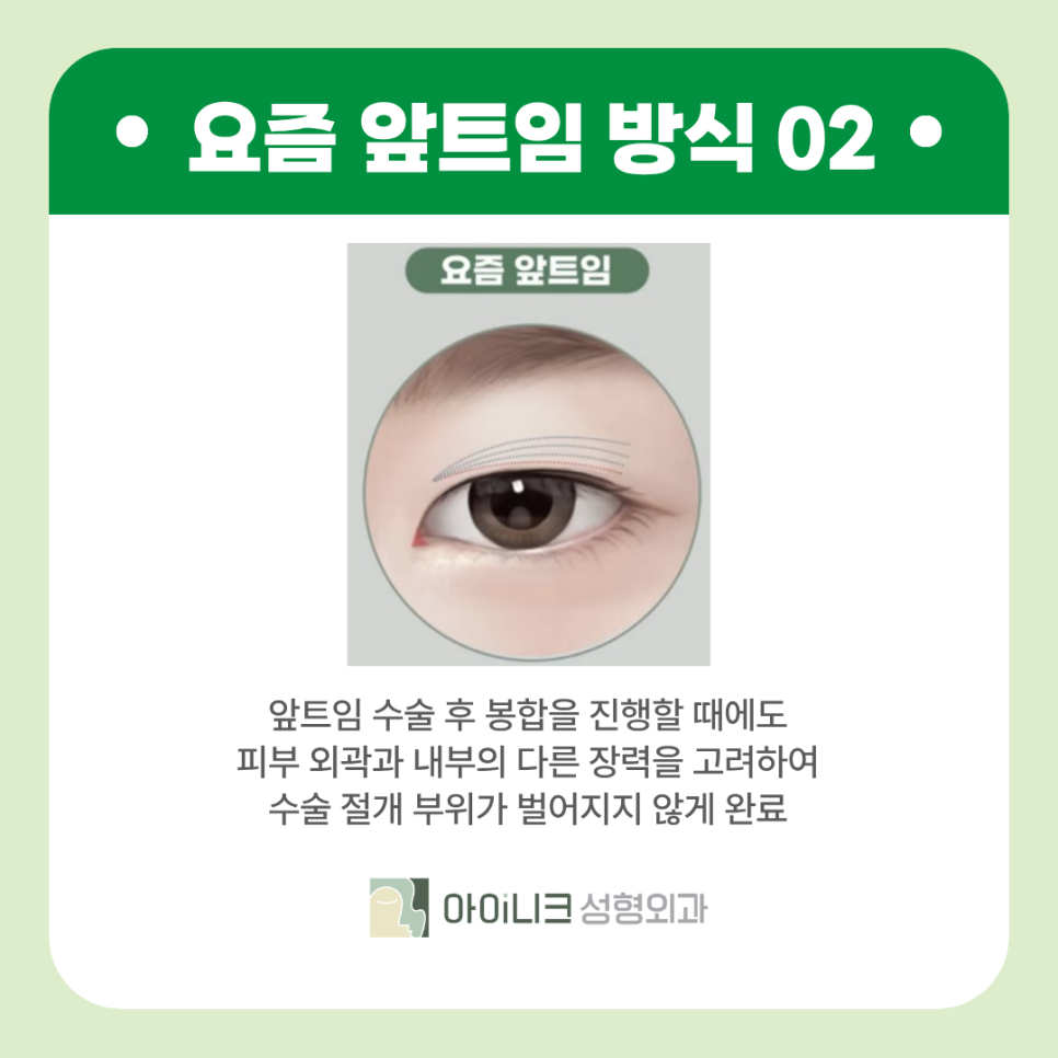 The 20s’ Pick These Days! An Epicanthoplasty Method Without Worrying About Scars image 8