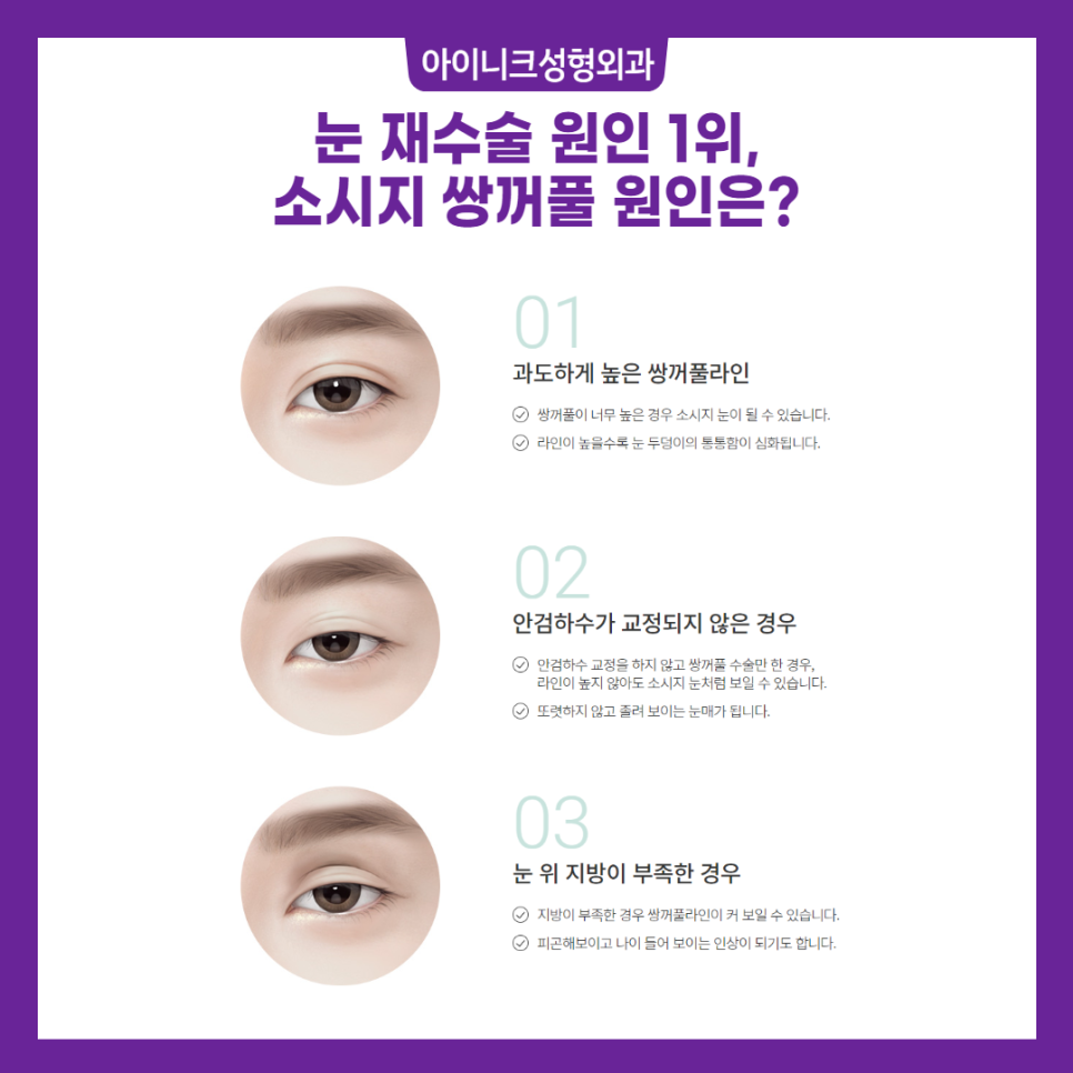실패 없는 압구정눈성형 재수술 플랜 관련 이미지 2