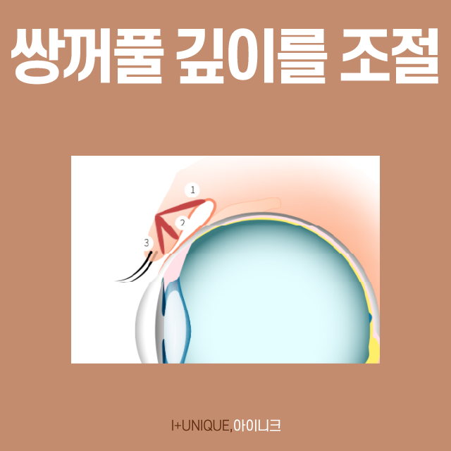 Ptosis and Eyelash Lift-Up: No More Stress! image 4