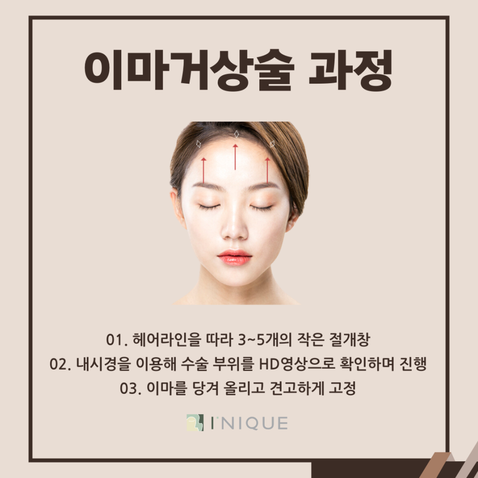 이마주름수술 깊은 고민 해결 관련 이미지 4