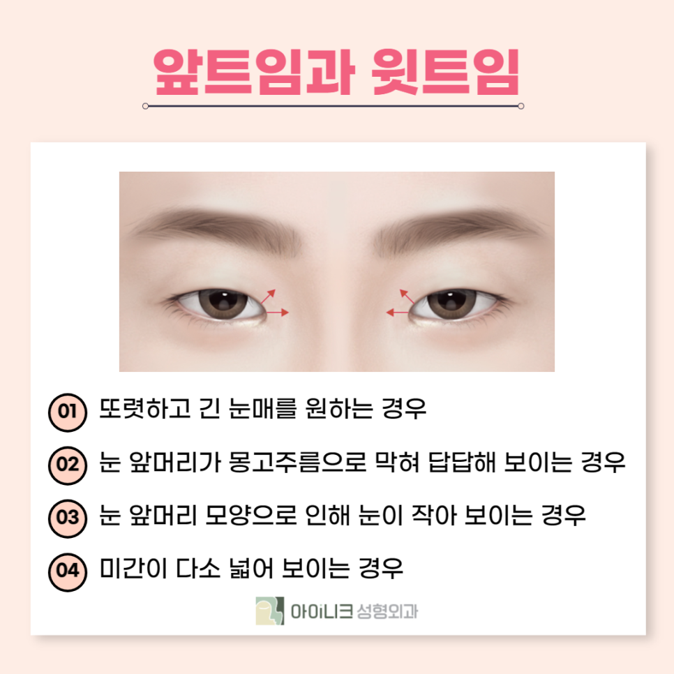 눈꼬리수술로 강아지상 만든 후기 관련 이미지 5
