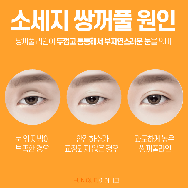 눈성형재수술, 어떻게 하면 자연스럽게 되돌릴 수 있을까 관련 이미지 3