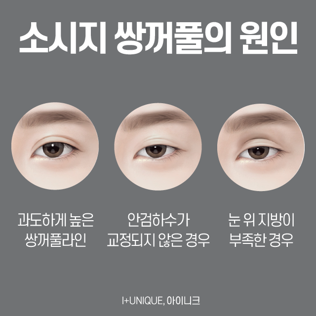 Sausage Double-Eyelid Correction: There Is No Second Failure! image 2