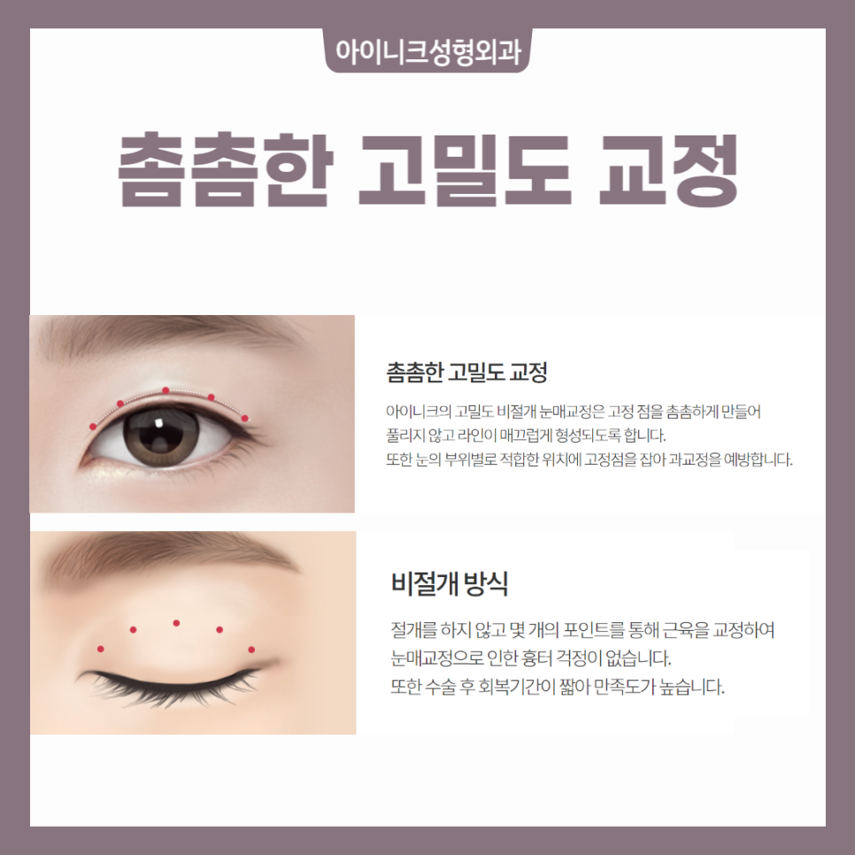 안검하수눈매교정 비절개 방식과 절개 방식 장단점과 추천 대상 관련 이미지 5