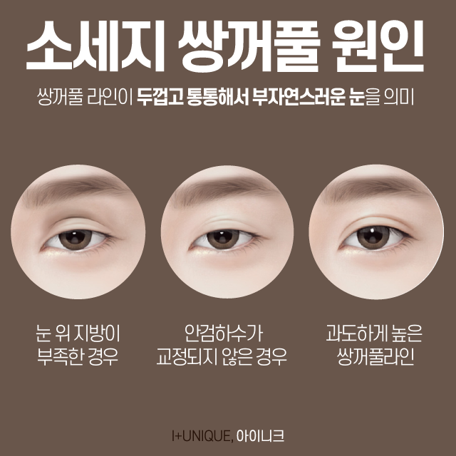 소세지쌍꺼풀, 더이상 속상한 채로 두지말고 아이니크성형외과로 관련 이미지 2