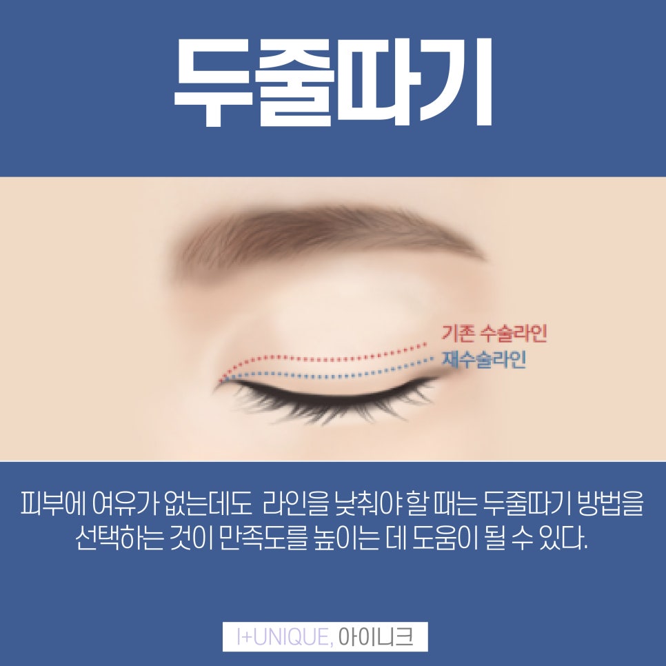 피부에 여유가 없는 쌍꺼풀도 소시지눈재수술이 가능하다 아이니크성형외과에서 관련 이미지 4