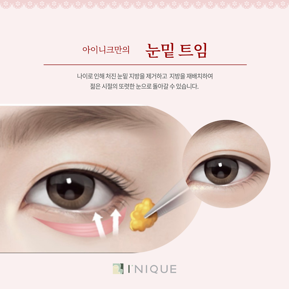 눈밑트임잘하는곳, 어떻게 선택할까요? 관련 이미지 2