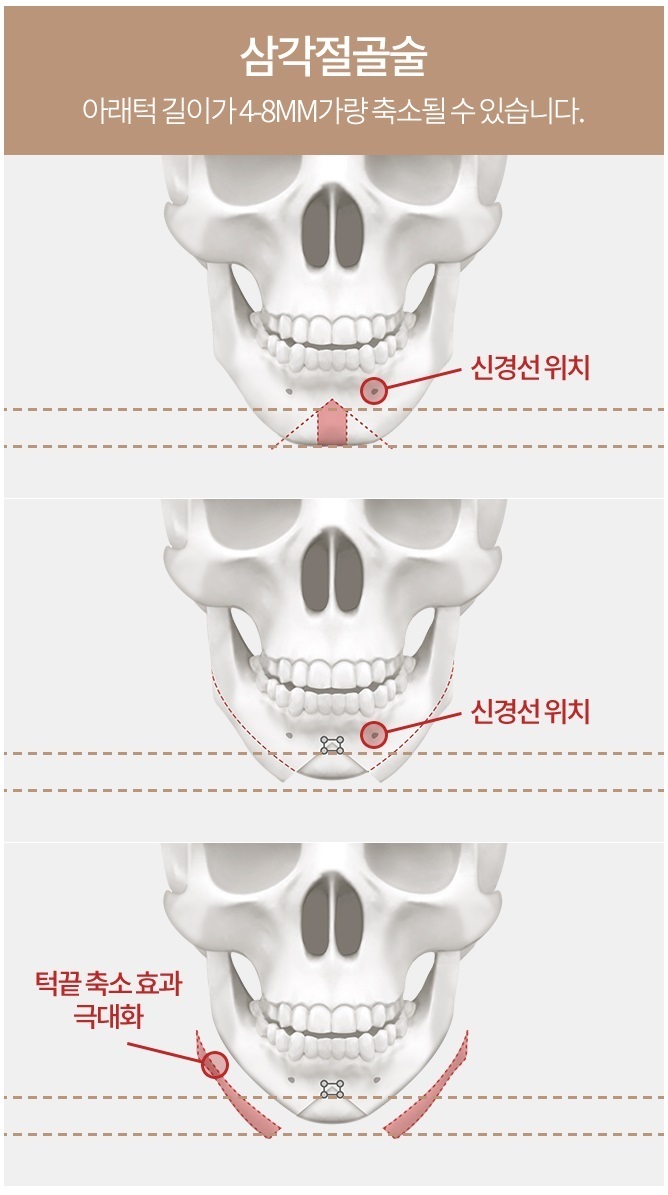 턱끝축소술비용 합리적인 선택, 아이니크! 관련 이미지 4