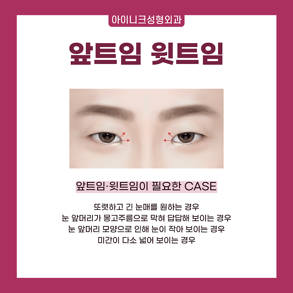 압구정 트임 수술 1위! 자연스럽고 확실한 인상 변화 관련 이미지 4