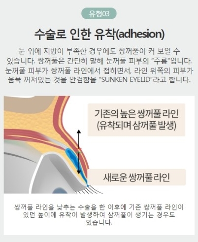 겹쌍꺼풀수술 원인별 맞춤 솔루션으로 완벽 해결! 관련 이미지 5