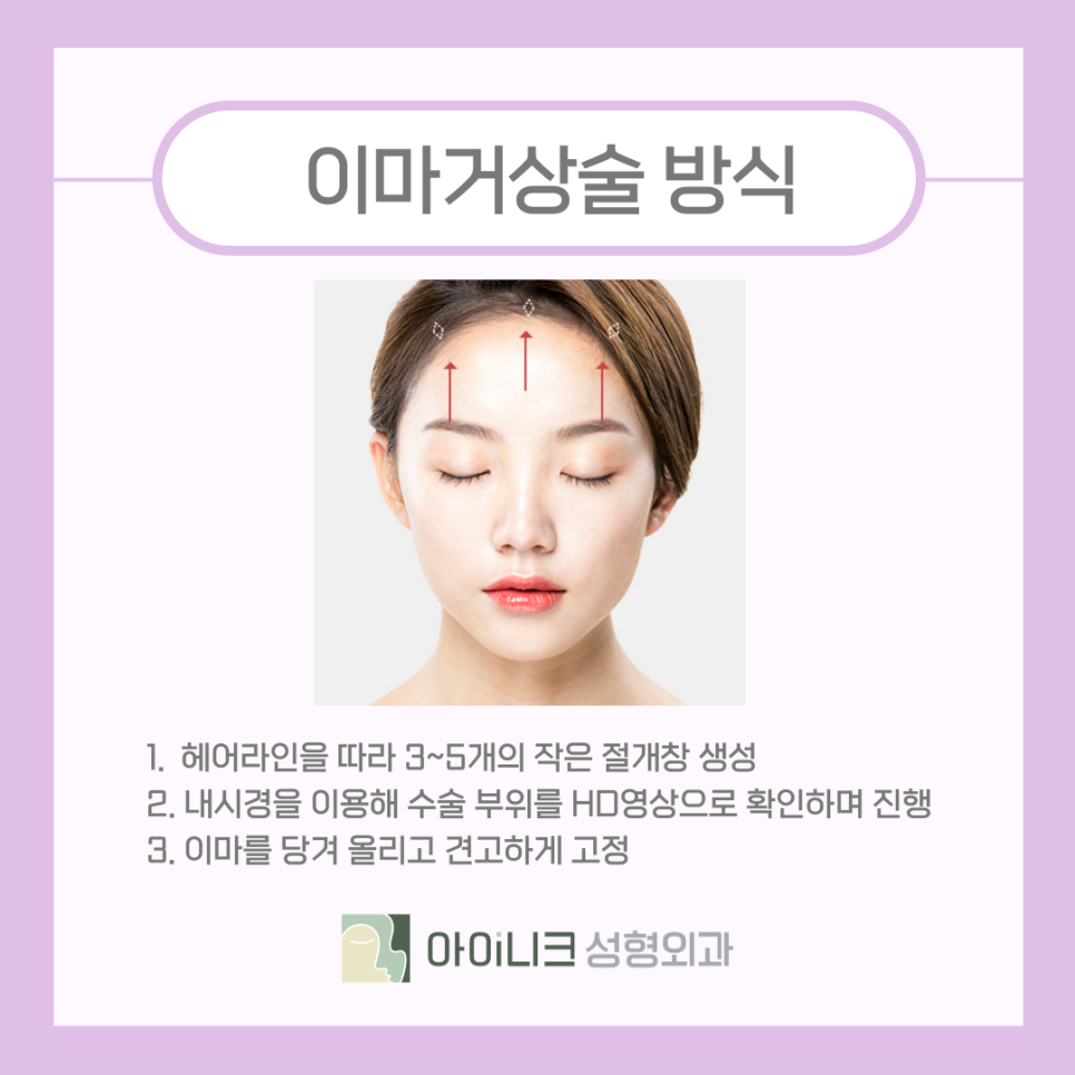 눈가리프팅 이마거상술로 올려주기 관련 이미지 7