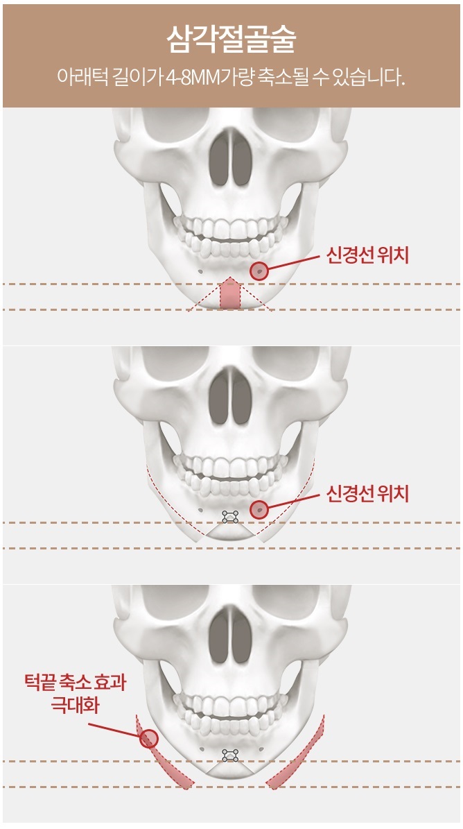 턱끝축소술비용 보다 절골법이 먼저! 관련 이미지 5