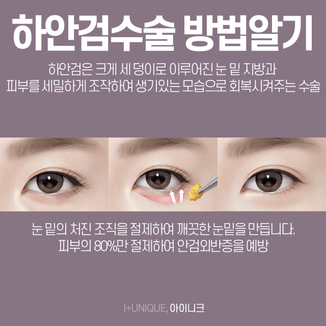 건강하고 환한 얼굴을 위한 하안검잘하는곳 알아보기 관련 이미지 2