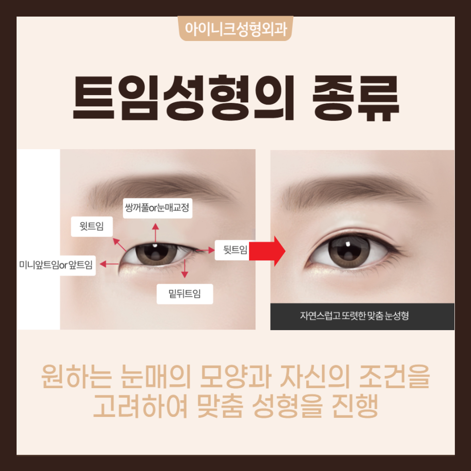 다양한 트임수술 같이 알아봐요! 관련 이미지 2