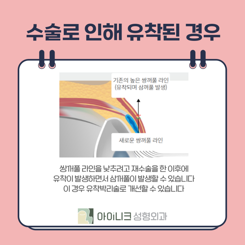 눈재수술로 삼꺼풀 부작용 해결하기 관련 이미지 9