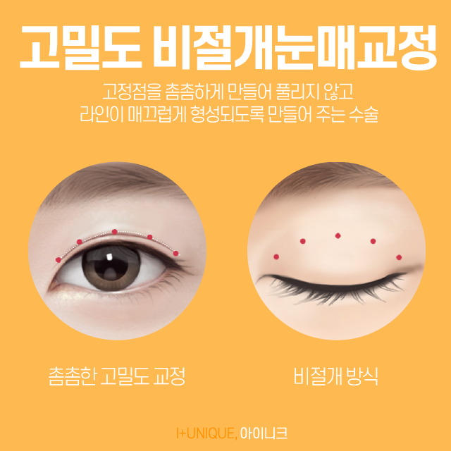 피곤해 보이는 눈을 다시 또렷하게 안검하수 잘하는곳 관련 이미지 4