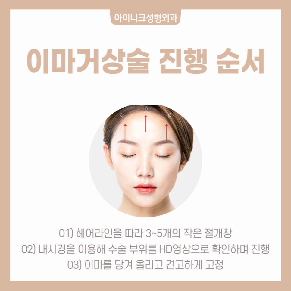 Forehead and Eyebrow Lift, Precisely with Safe Endotine image 4